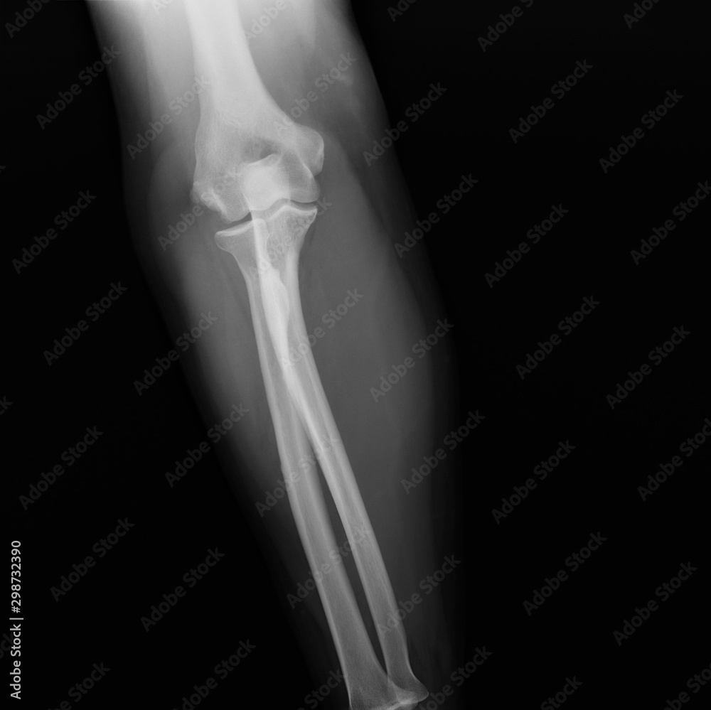 x-ray of the normal elbow joint. traumatology and orthopedics, medical diagnostics, rheumatology x-ray of the normal elbow joint. traumatology and orthopedics, medical diagnostics, rheumatology
