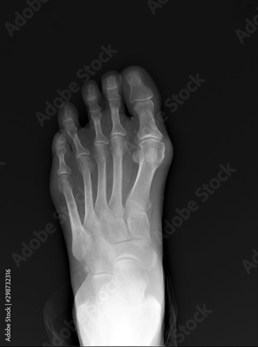 normal radiography of the foot, medical diagnostics, traumatology and orthopedics