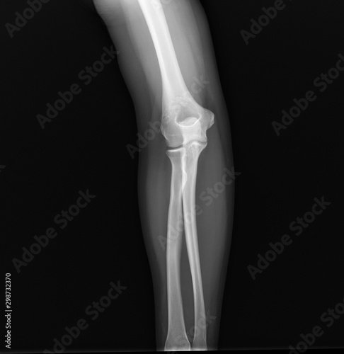 x-ray of the normal elbow joint. traumatology and orthopedics  medical diagnostics  rheumatology