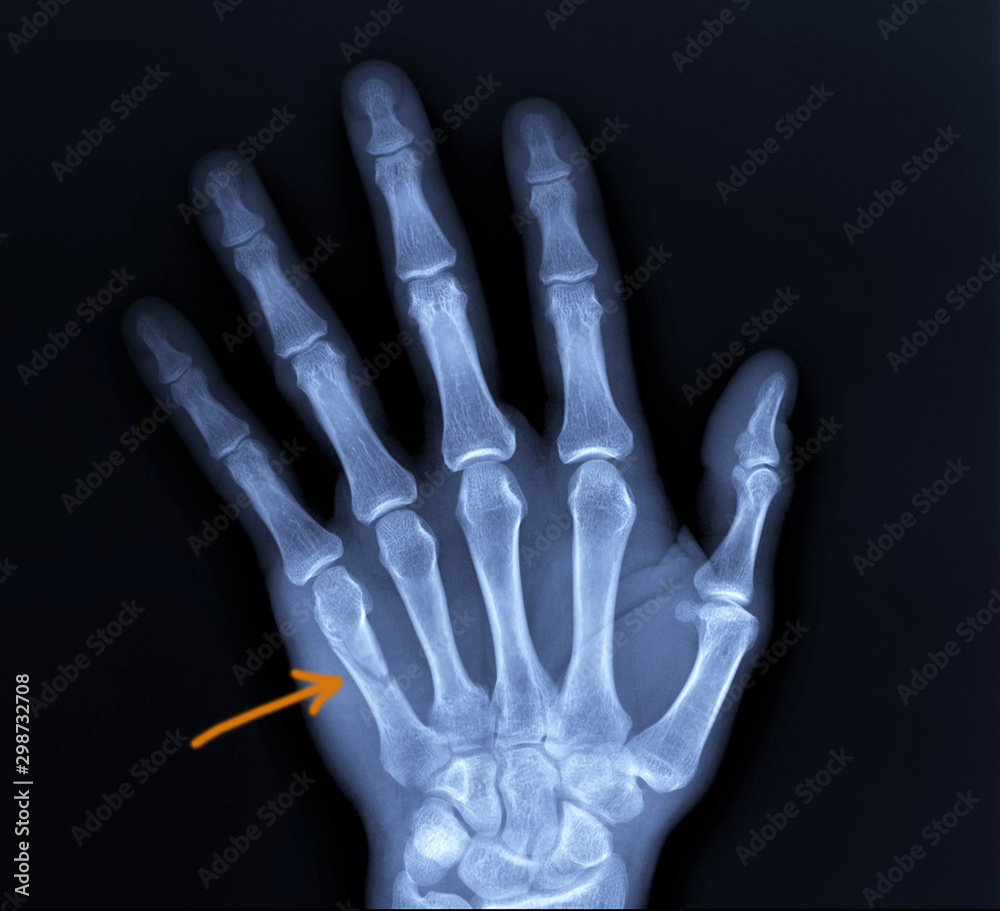 on the x-ray of the hand fracture of the fifth metacarpal bone, traumatology, medical diagnosis on the x-ray of the hand fracture of the fifth metacarpal bone, traumatology, medical diagnosis