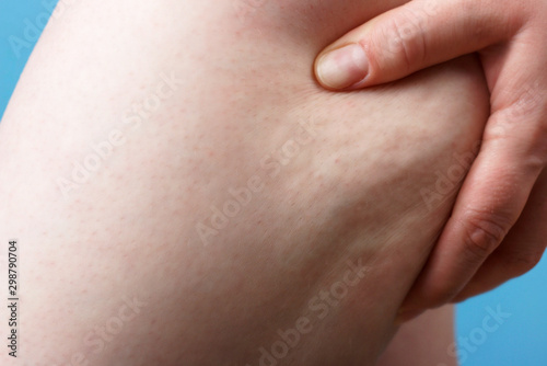 Female hand holds hip close-up on blue background, cellulite concept