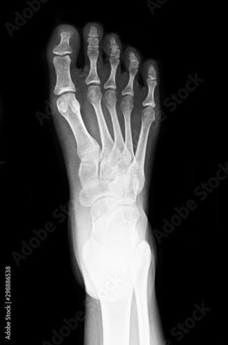 Foot x-ray image for use in treating patients. Patients with foot-related symptoms.