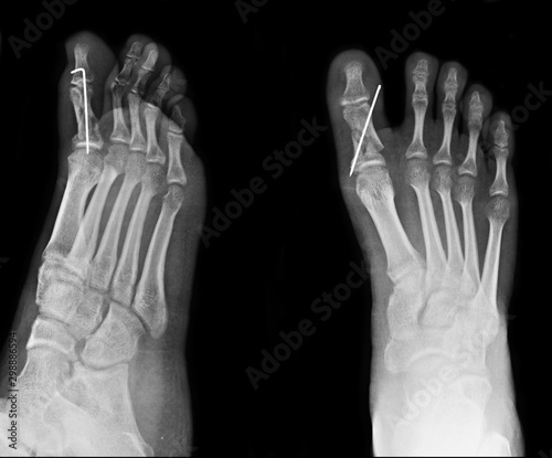  Foot x-ray image for use in treating toe fractures.