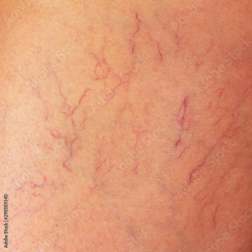 varicose veins on the thigh of a woman close up