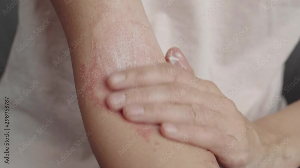 woman applies a dermatitis cream woman applies a dermatitis cream