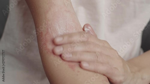 woman applies a dermatitis cream