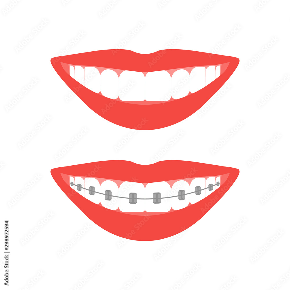 Beautiful smiling mouth with braces on teeth before and after. Design concept. Vector illustration
