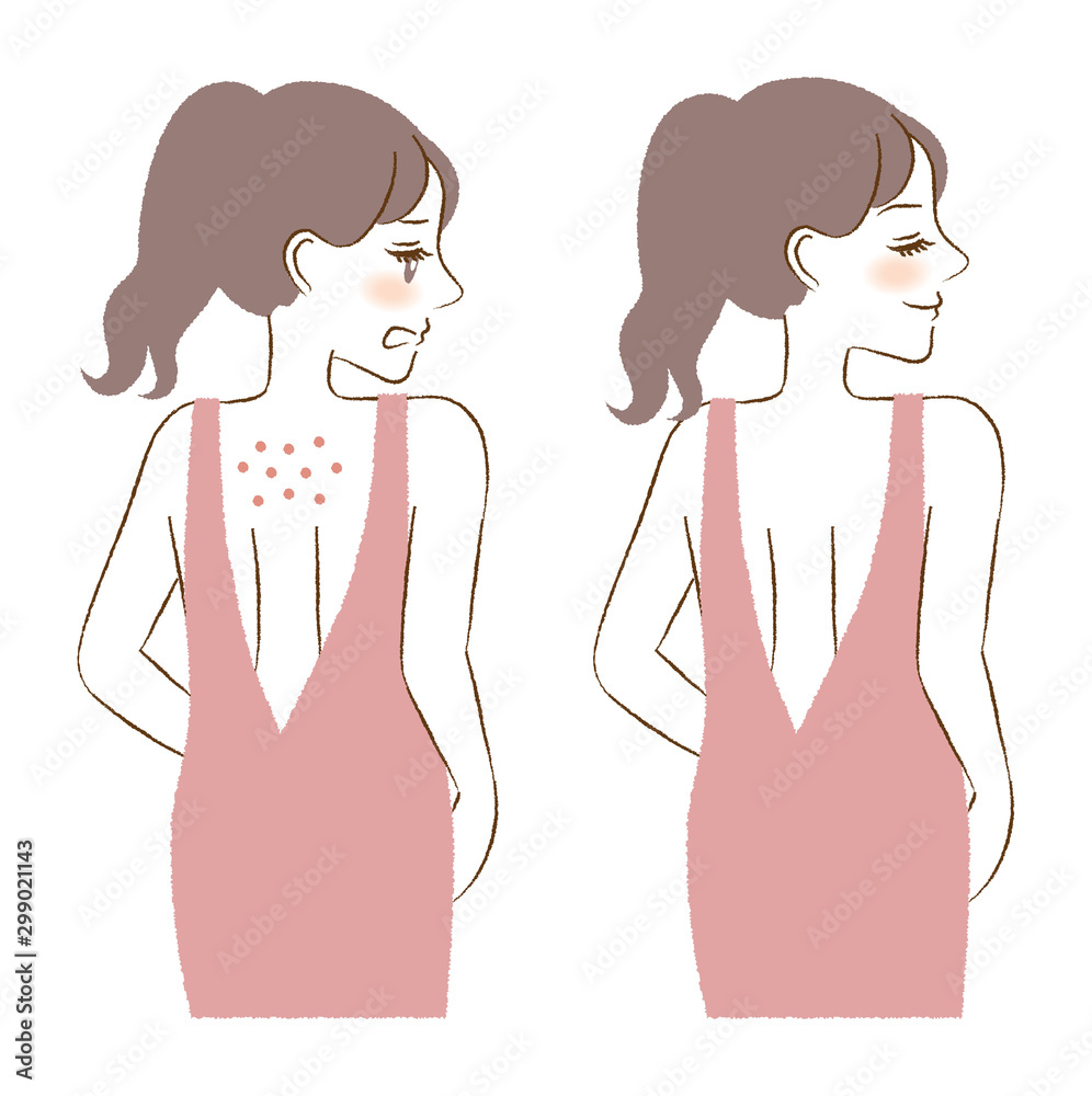 A woman with acne on her back