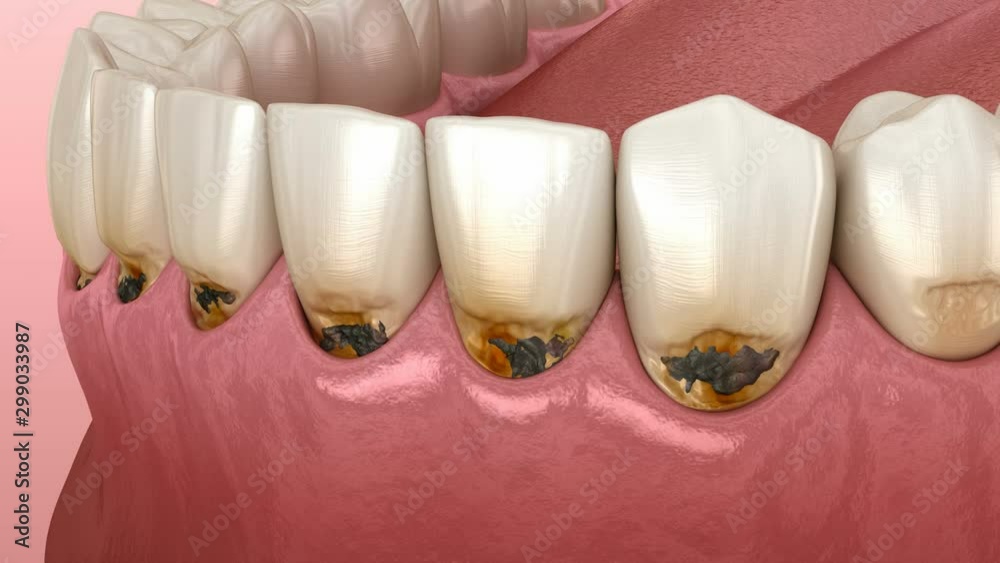 Cervical caries on frontal teeth. Medically accurate tooth 3D animation ...