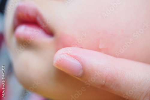 mother applying topical antihistamine cream at kid face with skin rash and allergy with red spot cause by mosquito bite