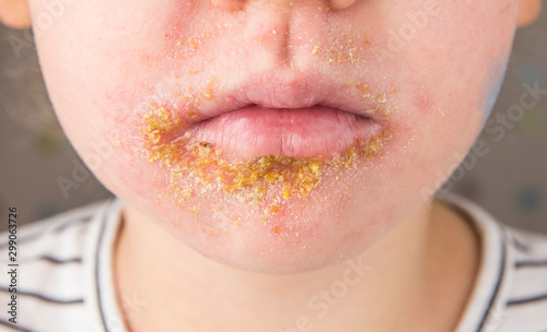 5 year old child with Impetigo (nonbullous impetigo) witch is is a bacterial infection that involves the superficial skin. Yellow scabs on infected area.