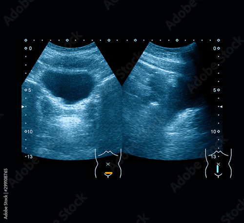 Ultrasound images of bladder, a case of medullary nephrocalcinosis of kidney, a 13 year old Asian boy