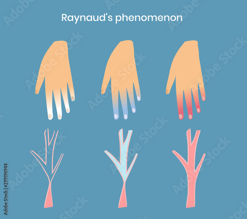 Raynaud's disease and syndrome