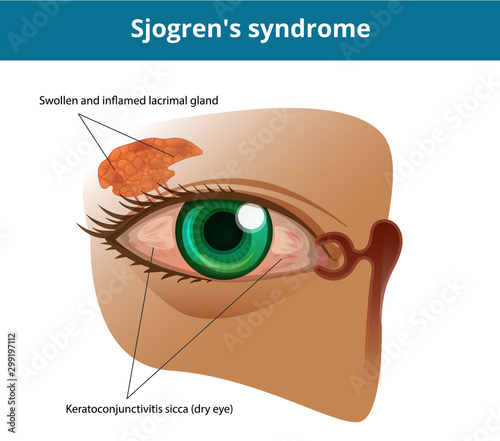 Sjogren's syndrome or dry eye syndrome. Keratoconjuctivitis sicca photo