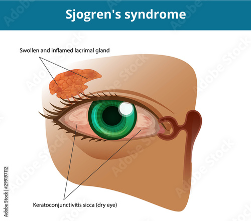 Sjogren's syndrome or dry eye syndrome. Keratoconjuctivitis sicca