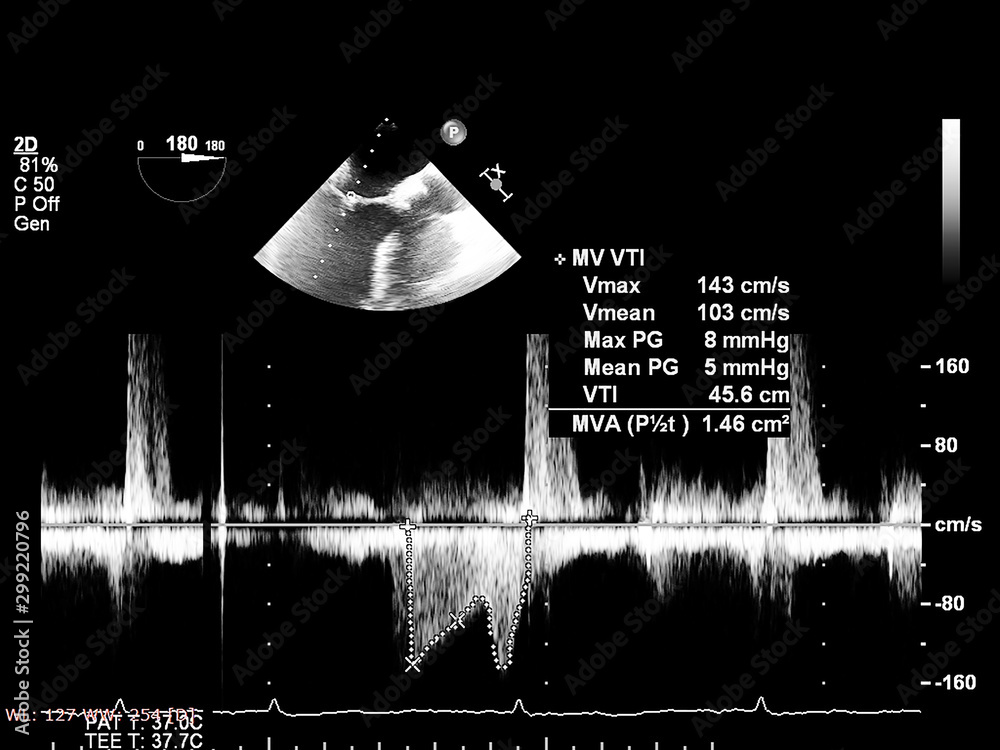 Screen of echocardiography (ultrasound) machine. Stock Photo | Adobe Stock