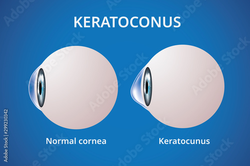 Eye cornea and keratoconus, eye disorder, medical vector