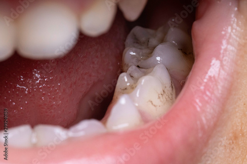 Human tooth decay, plaque, caries close up photo