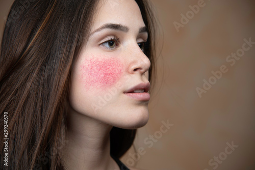 Beautiful young woman with rosacea