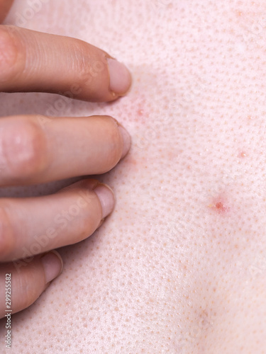 Woman dealing with pimples red spots