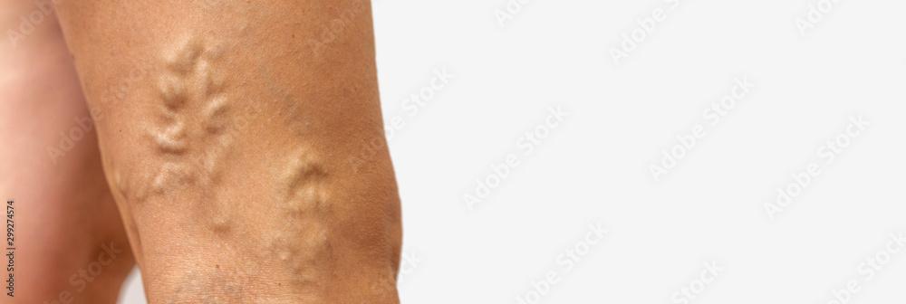 Legs pain concept - legs tied with rope isolated on white Legs pain concept - legs tied with rope isolated on white