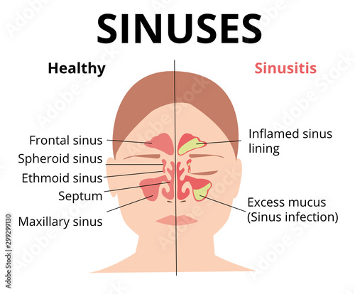 Sinusitis medical treatment. Nasal sinus. Healthy and inflammation sinus. Nasal diseases. Sinusitis, sinus infection diagnosis  medical infographic design.