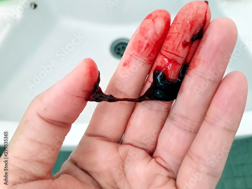 Hand stain Deep red blood clot in hand Symptoms of hemorrhage are life threatening When there is blood flowing out of the body, should seek medical attention to treat. photo