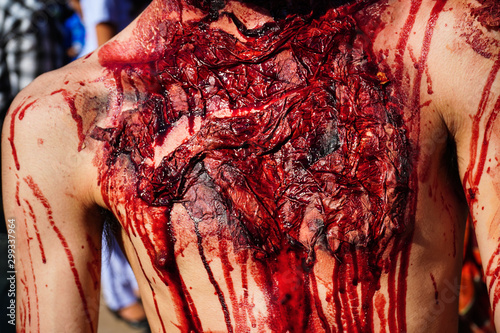 Traumatic injury patients with blood in the emergency room after the accident