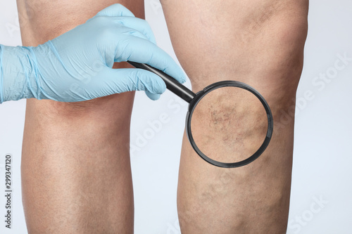 doctor shows the dilation of small blood vessels of the skin on the leg. Medical inspection and treatment of Telangiectasia, cosmetology photo