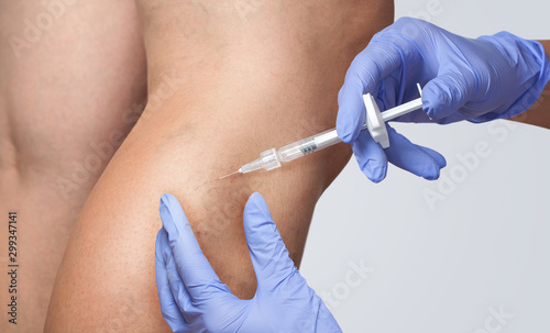 A doctor does medical procedure Sclerotherapy used to eliminate varicose veins and spider veins. An injection of a solution directly into the vein. photo