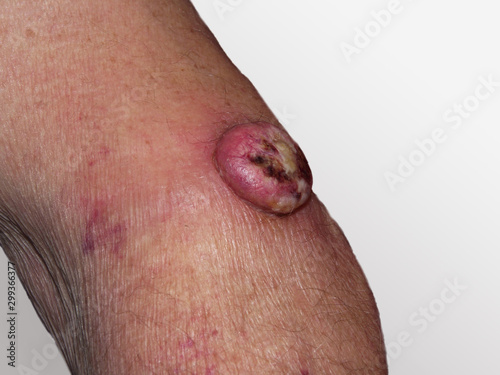 Bösartiger Tumor auf Haut eines Mannes
