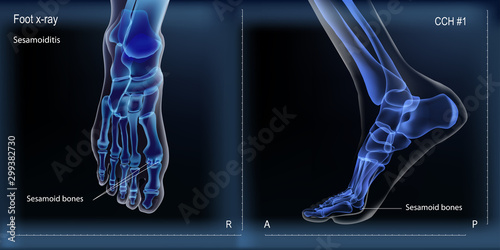 Medial and top view x ray of bones the of foot with sesamoid. photo