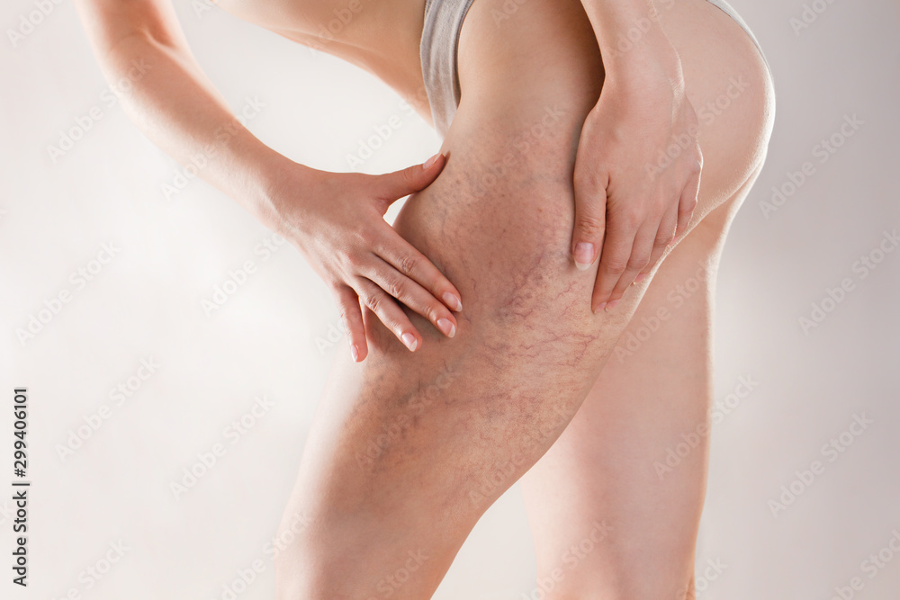 Medicine and varicose veins. A young woman of athletic build clutches her leg with a varicose mesh on her hip, in a half-bent position. Copy space
