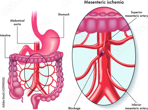 Medical illustration showing a mesenteric  ischemia also called intestinal infarction, a blockage of blood circulation, affecting  the mesenteric artery.