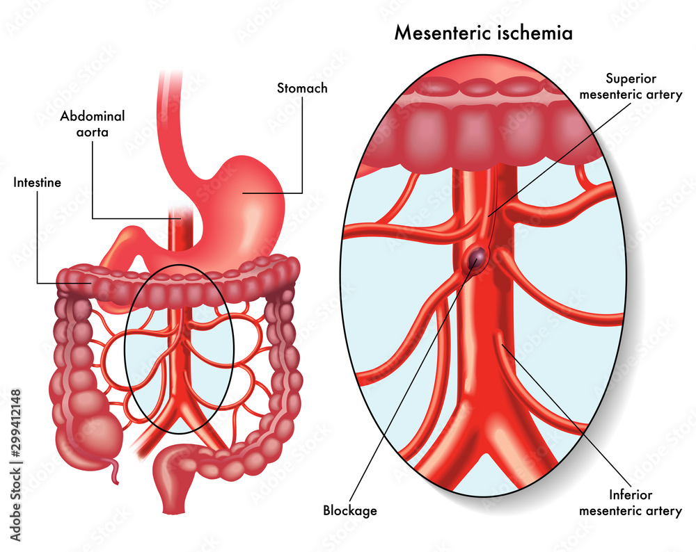 L'infarto intestinale è una sindrome anatomo clinica caratterizzata da necrosi ischemica della parete intestinale. Nell'infarto intestinale si assiste alla necrosi di un tratto di intestino per interruzione - totale o parziale, acuta o cronica - del flusso sanguigno locale.L'infarto intestunale riconosce forme acute e forme croniche.L'infarto intestinale rappresenta l'1-2% delle cause di addome acuto.Nell'infarto intestinale del tenue, la diagnosi deve essere quanto più possibile precoce.Il quadro sintomatologico dell'infarto intestinale presenta caratteristiche simili a quelli dell' addome acuto, il che giustifica l'elevata frequenza di errori diagnostici.In tutti i casi di infarto intestinale è necessaria una terapia di supporto, se  possibile, una terapia causale.L’infarto intestinale può interessare l’intestino tenue o il crasso, comportando dei quadri clinici differenti.