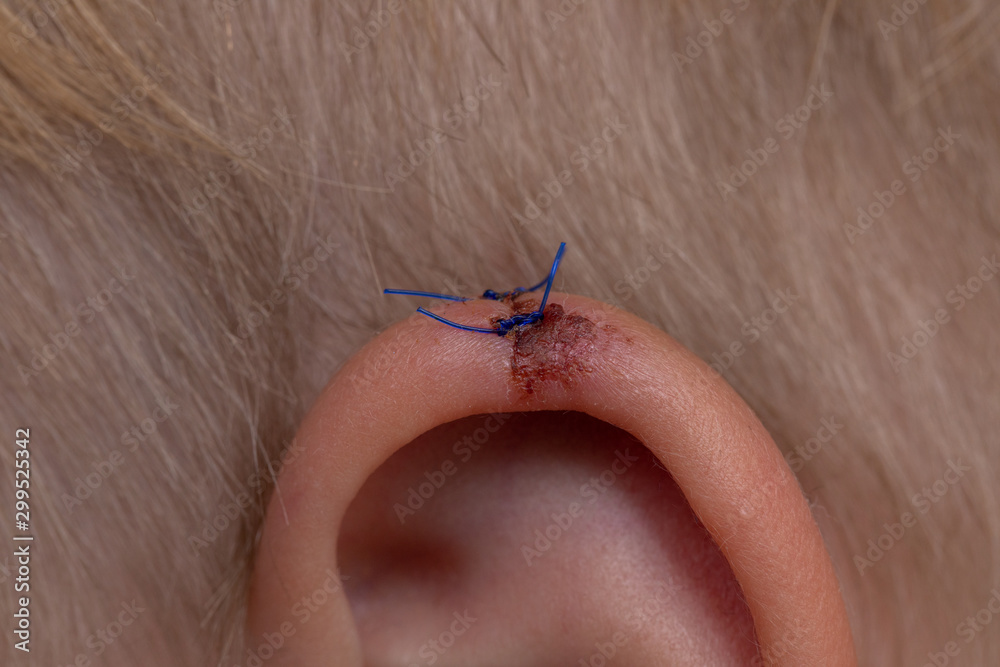 Obraz premium Torn wounds with stitches one child ear. close-up of laceration human ear with suture. wound stitches. Medical, surgical concept.