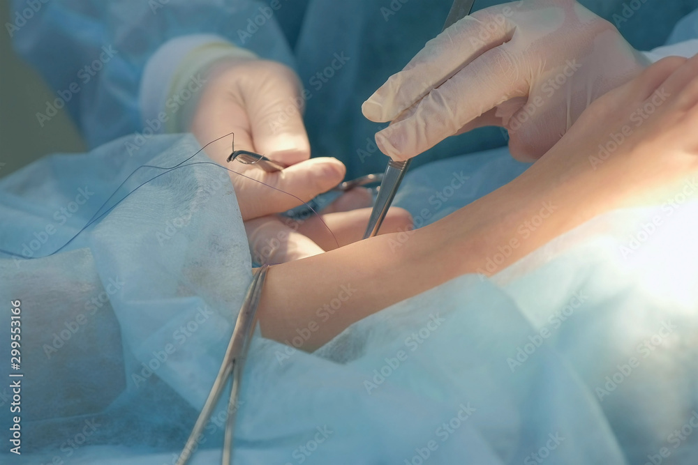Surgeon man sutures ankle during surgery with neat stitches after removing hygroma using clip, hands closeup. Doctor sewing on wound in operating room in hospital. Seams with self-absorbable threads. Surgeon man sutures ankle during surgery with neat stitches after removing hygroma using clip, hands closeup. Doctor sewing on wound in operating room in hospital. Seams with self-absorbable threads.