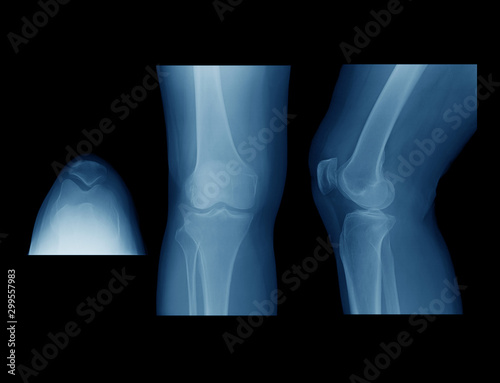 X-ray image of osteoarthritis of the Knee (Degenerative Arthritis of the Knee)