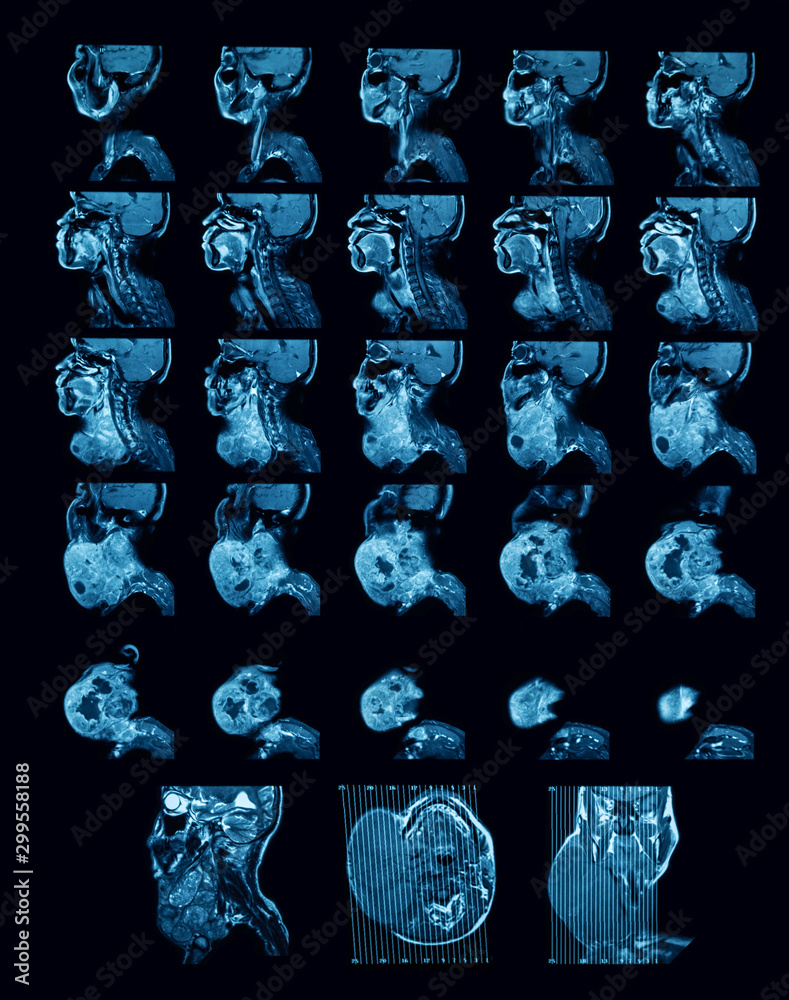 resonance imaging (MRI scan) of neck, coronal view, a case of