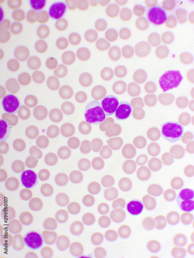 Blood picture of chronic lymphocytic leukemia or CLL, analyze by microscope, original magnification 1000x