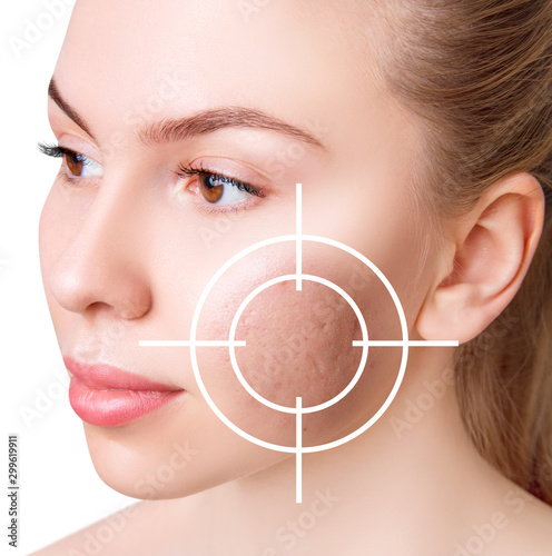 Aiming on the skin with postacne and scarring on woman face.