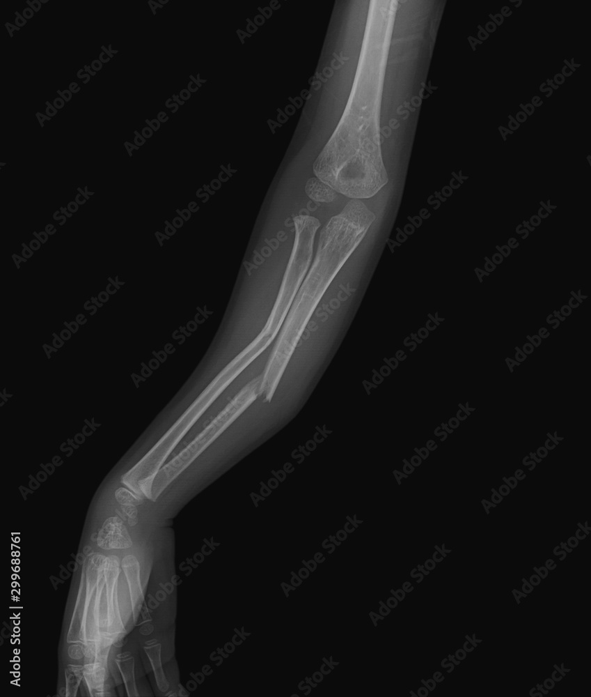Right forearm xray image, front view, show ulna and radius bone