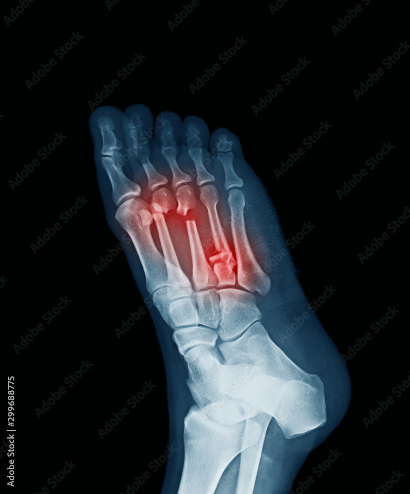 Computed radiography (CR) of foot, oblique view, showing wonud and metatarsal bone fractures Computed radiography (CR) of foot, oblique view, showing wonud and metatarsal bone fractures