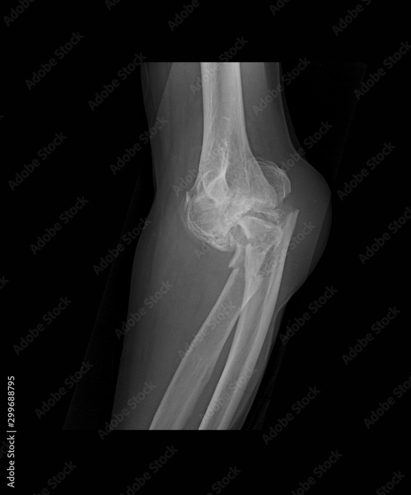 Xray image of left elbow with wooden splint, lateral view, showing
