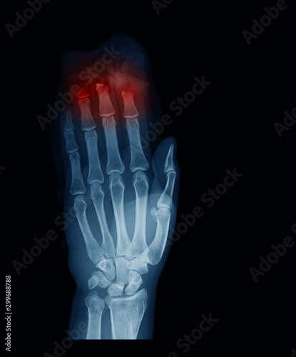 Photography Right hand x-ray image showing the fingertips are cut by a saw, anteropisterior