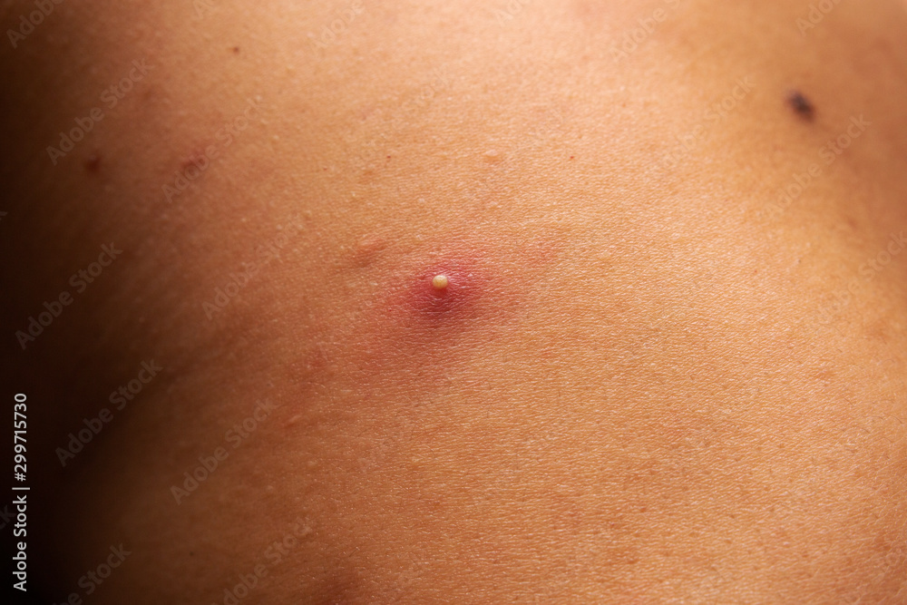 Closeup big acne on teenage body. Big abscess on a man’s back.