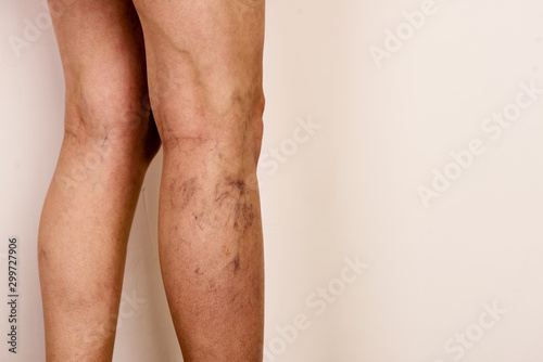 Varicose veins on a slim female legs. Phlebology