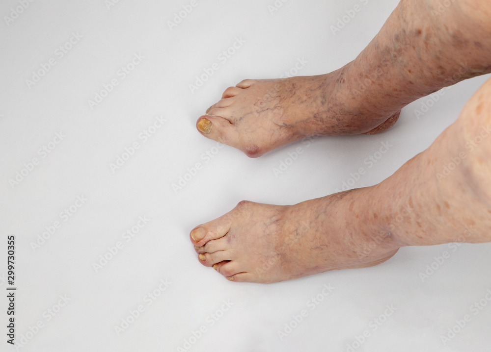 Inflammation of the joints of the lower extremities in an elderly person. Pain syndrome and deformation of the foot with arthritis.Rheumatoid arthritis of the lower extremities of an elderly person. Inflammation of the joints of the lower extremities in an elderly person. Pain syndrome and deformation of the foot with arthritis.Rheumatoid arthritis of the lower extremities of an elderly person.