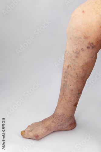 Inflammation of the joints of the lower extremities in an elderly person. Pain syndrome and deformation of the foot with arthritis. Varicose veins in the legs.
