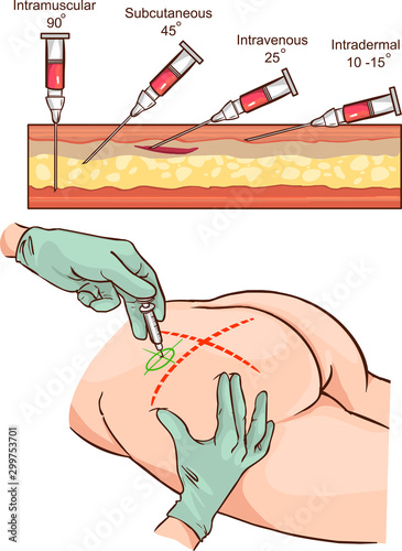 Intramuscular injection vector illustration and   Comparison of the angles of intramuscular injection.